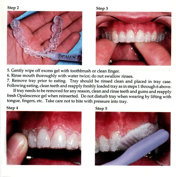 33575 custom teeth whitening trays