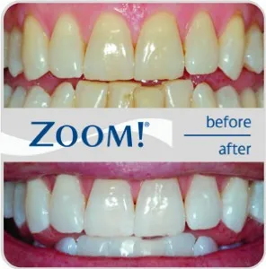 33575 sensitive teeth