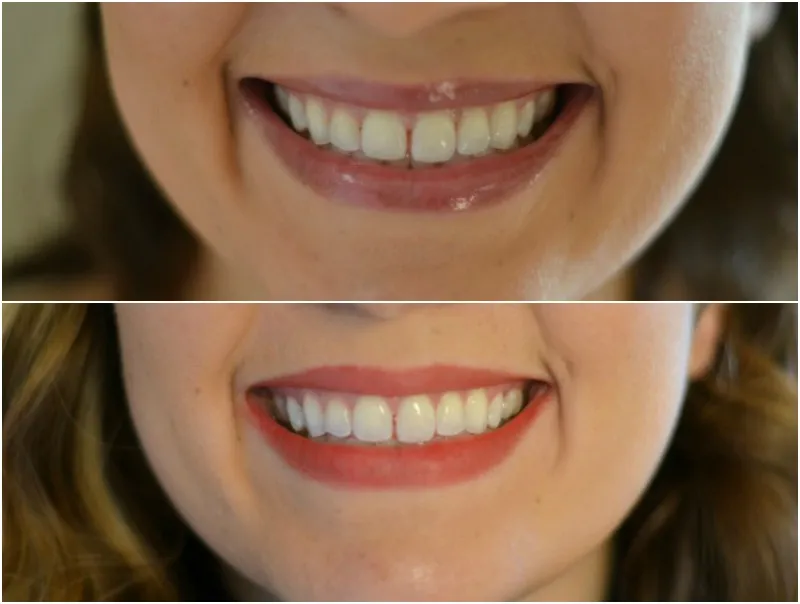 /img/33584-crest-whitening-strips-guide.webp