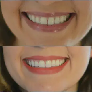 /img/33584-crest-whitening-strips-guide.webp