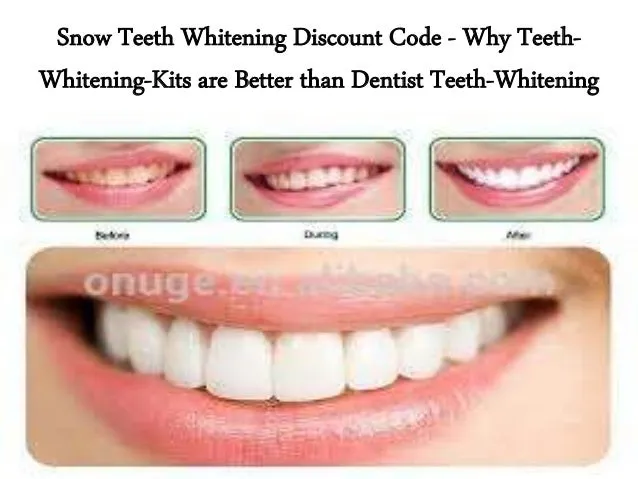 33593 snow teeth whitening before after