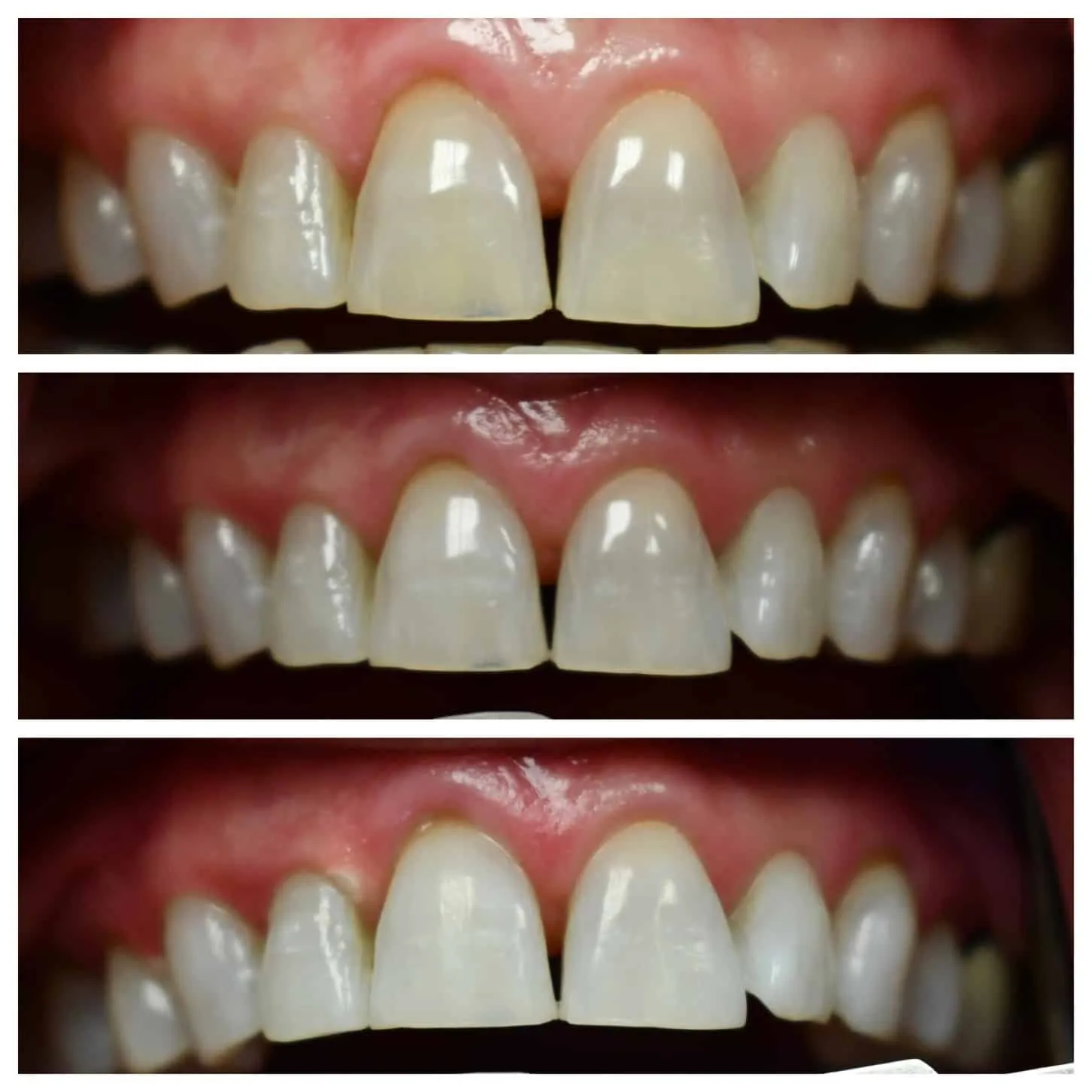 33602 teeth whitening brentwood before after