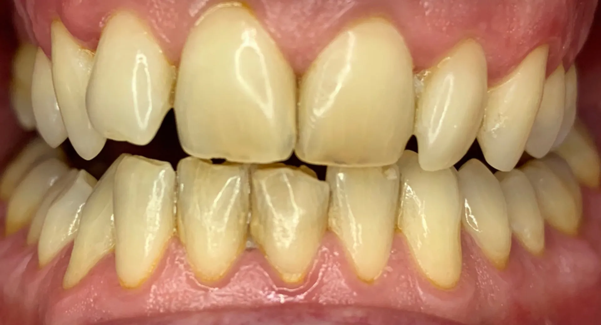 33602 teeth whitening brentwood dentist