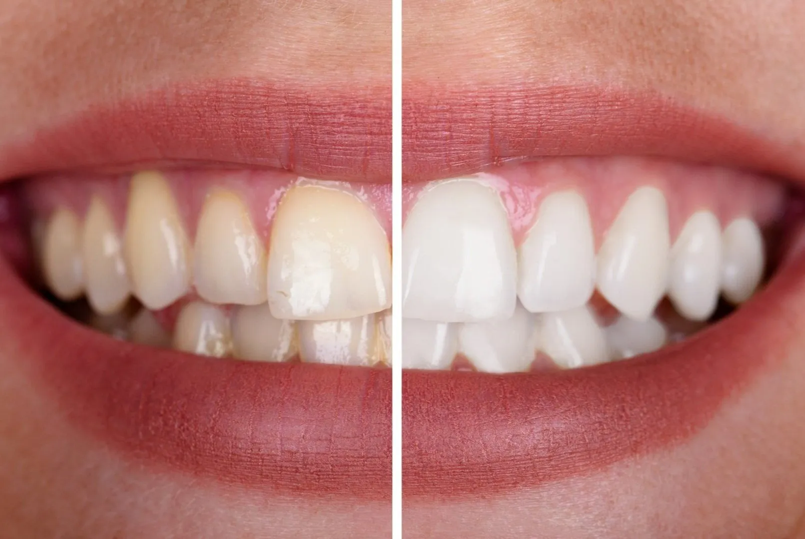 33607 teeth whitening logan ut stains