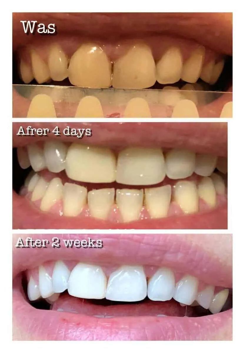 33615 snow teeth whitening before after