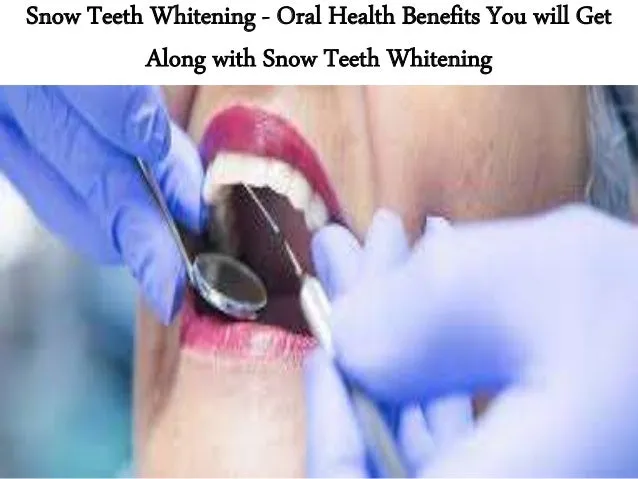 33615 snow teeth whitening kit