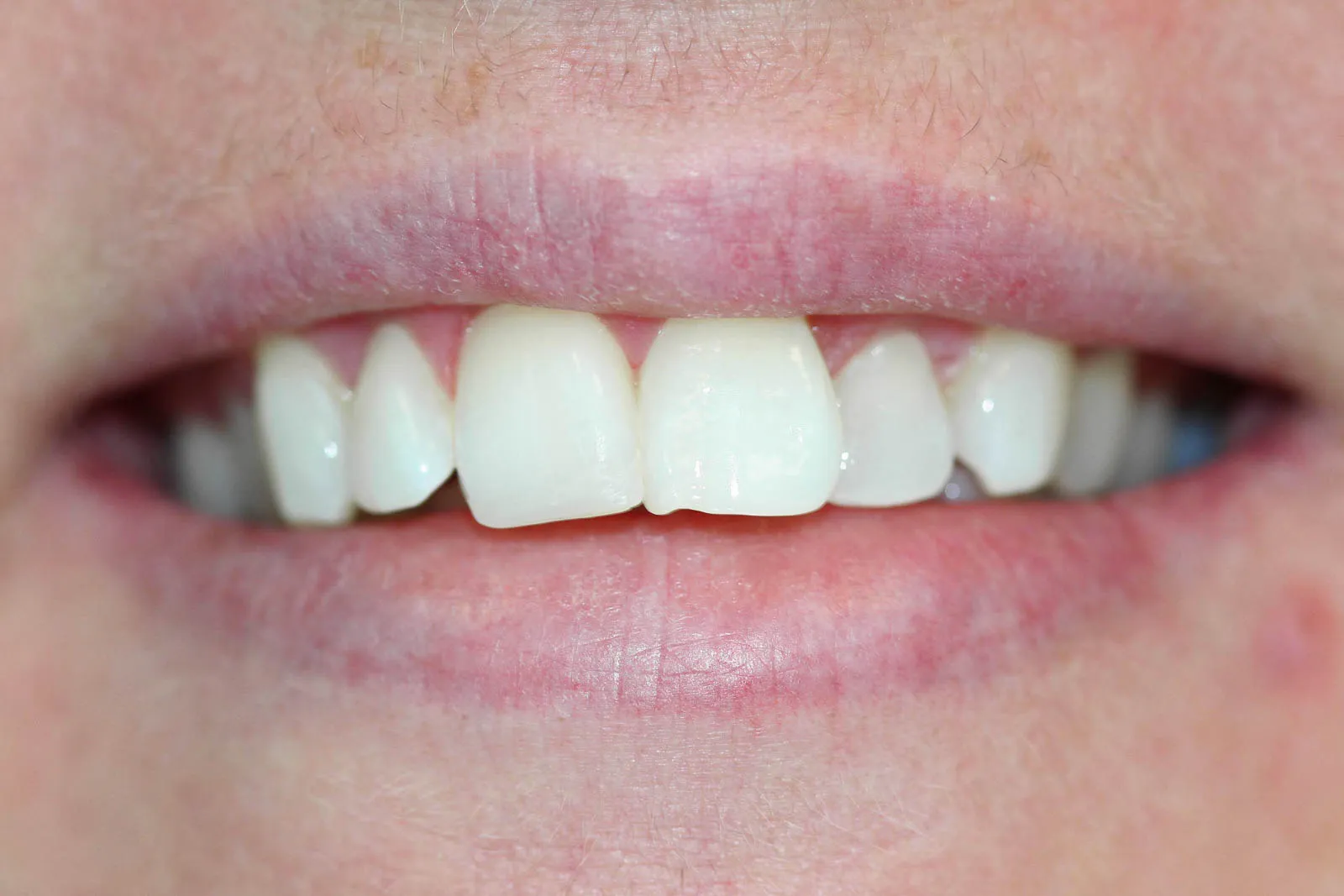 33619 teeth whitening options