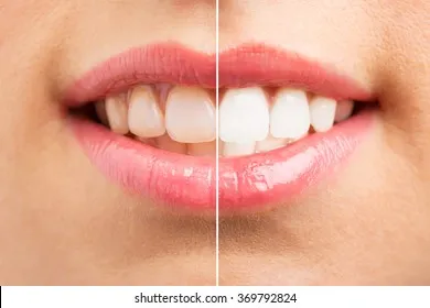 33622 maintaining teeth whiteness