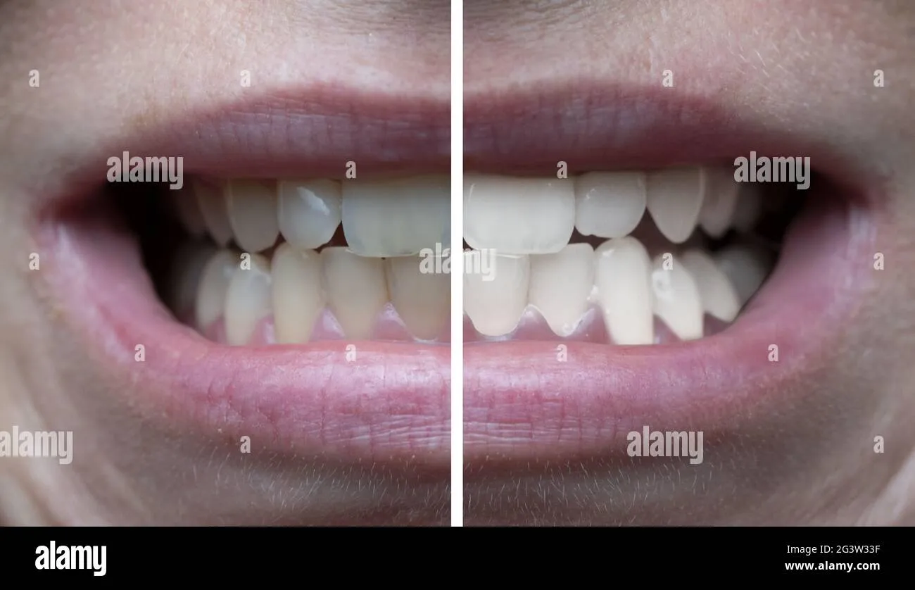 33622 professional teeth whitening