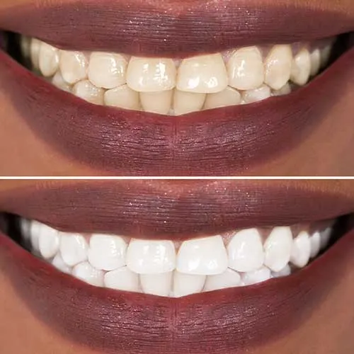 33622 take home teeth whitening
