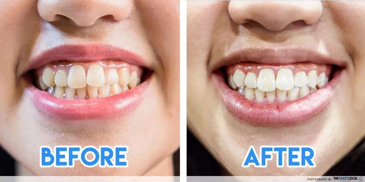 33622 teeth whitening before after