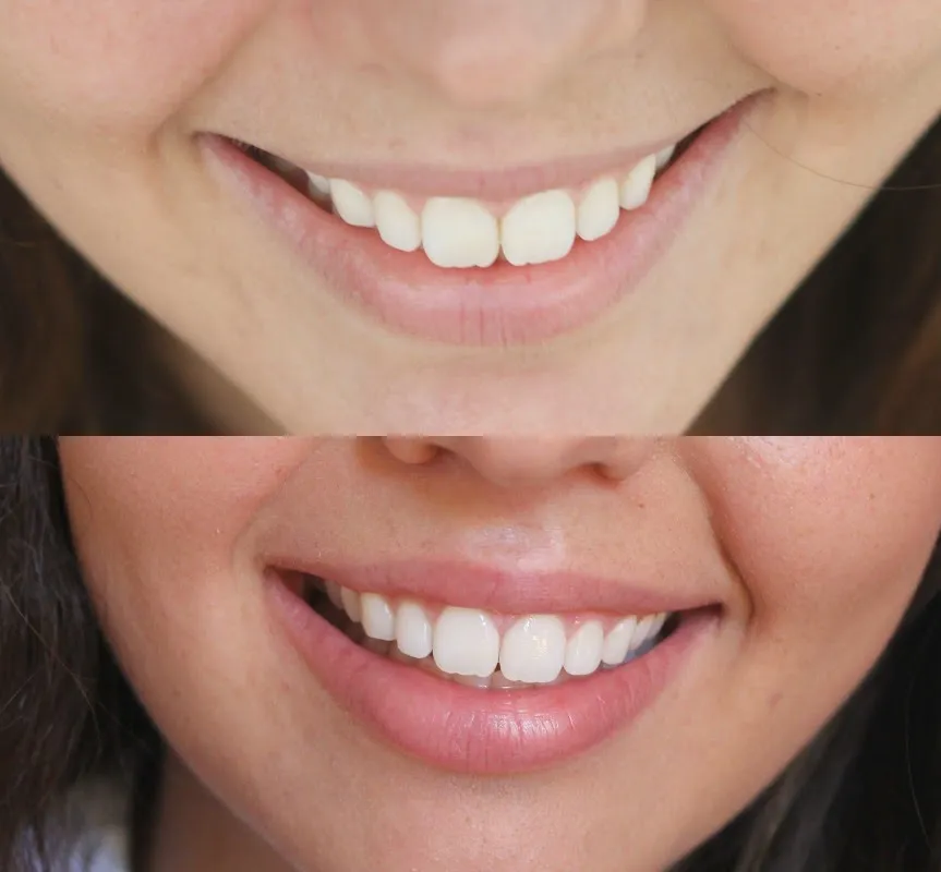 /img/33625-easy-smile-teeth-whitening-confidence.webp