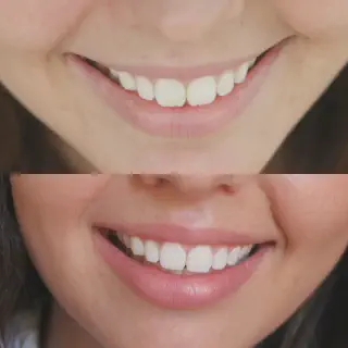 /img/33625-easy-smile-teeth-whitening-confidence.webp