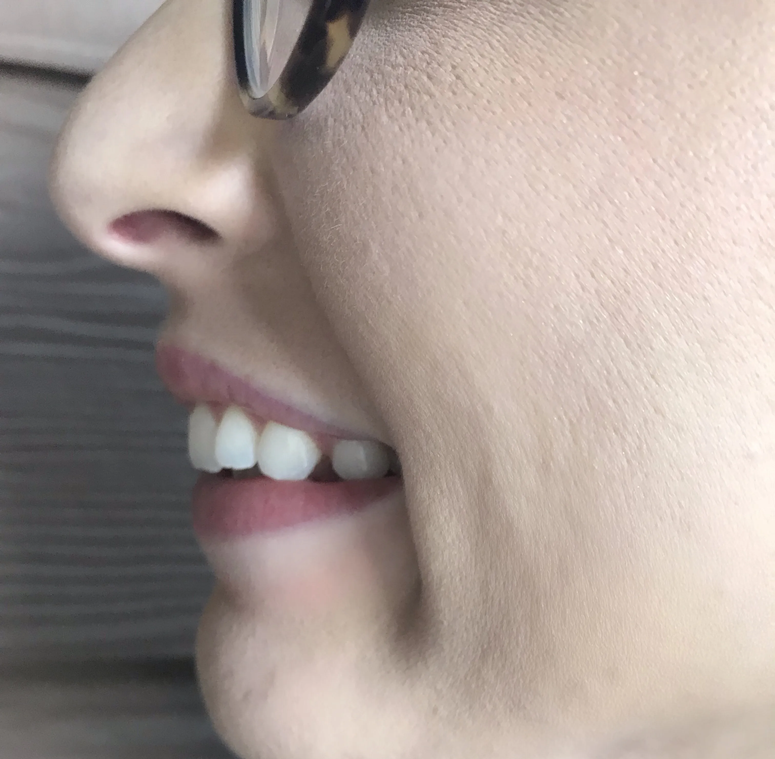 33625 easy smile teeth whitening smile