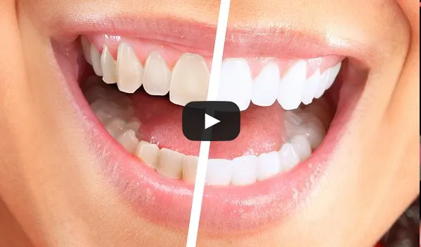 33629 teeth whitening buffalo ny professional