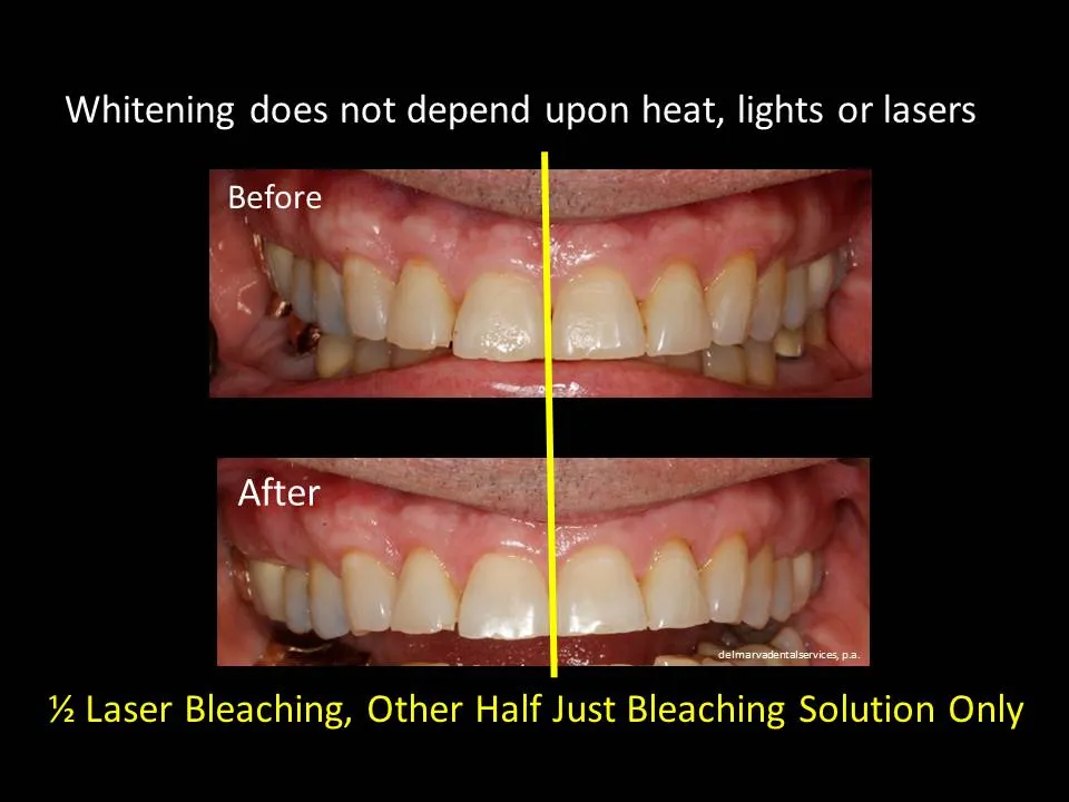 33632 hydrogen peroxide teeth whitening safe 6