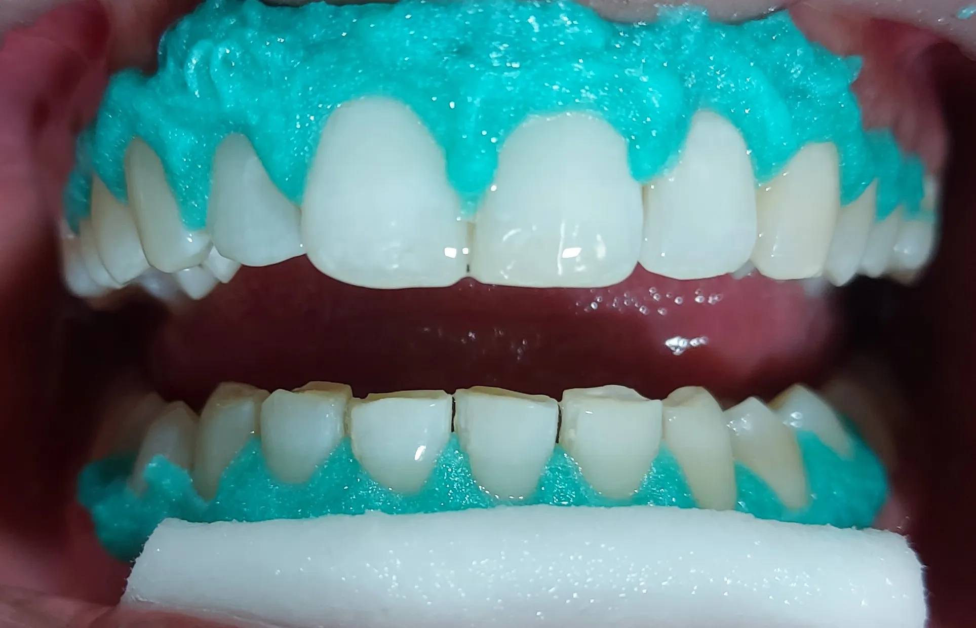 33638 oxygen teeth whitening kit