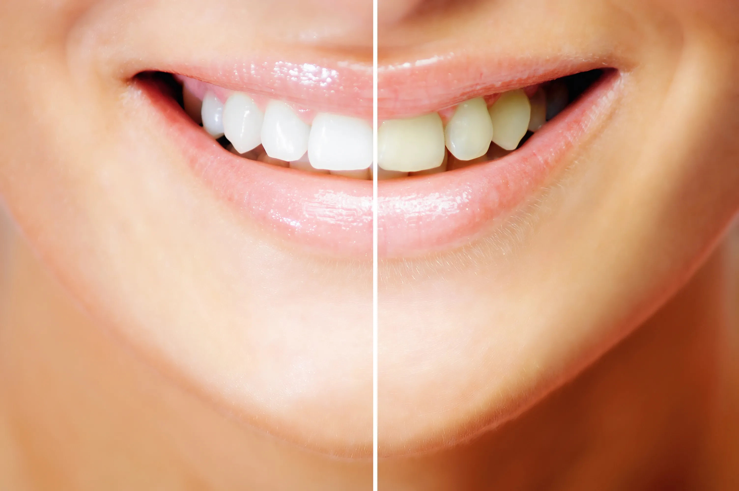 33638 oxygen teeth whitening results