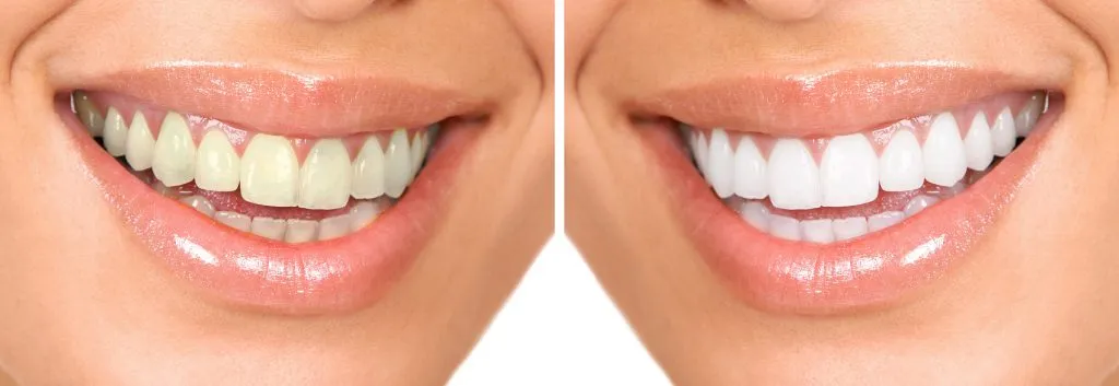 /img/33638-oxygen-teeth-whitening-sensitivity.webp