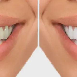 /img/33638-oxygen-teeth-whitening-sensitivity.webp