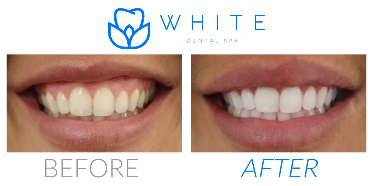 33639 zoom teeth whitening tampa cost