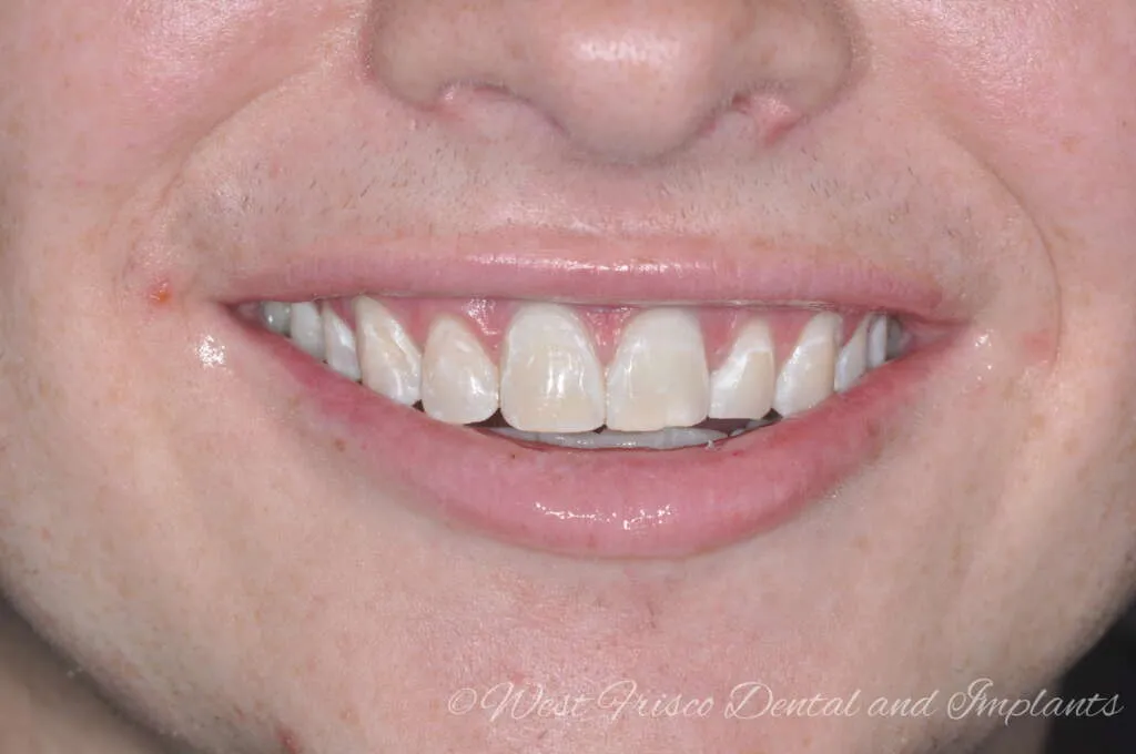 33639 zoom teeth whitening tampa procedure