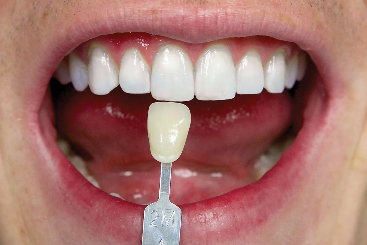 33639 zoom teeth whitening tampa smile