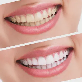 /img/33640-teeth-whitening-ri-cost-factors.webp