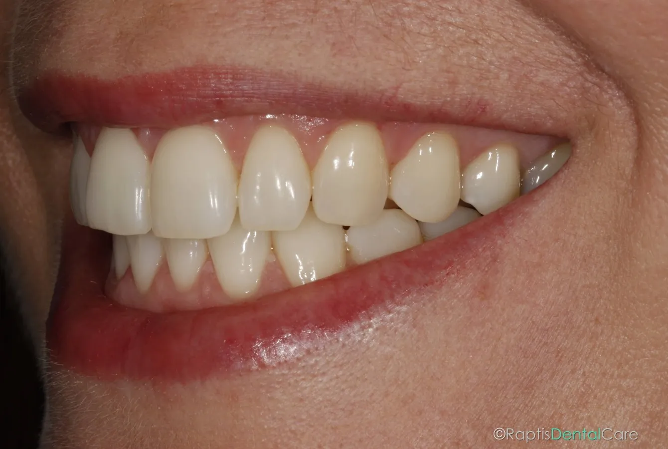 33640 teeth whitening ri lasting smile