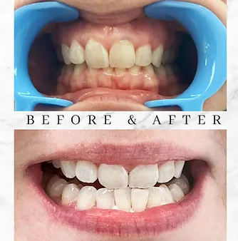 33651 teeth cleaning diamond bar