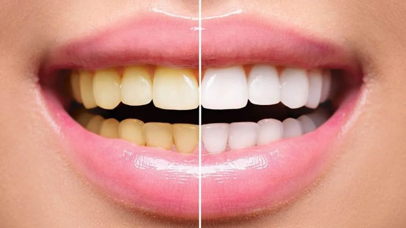 33662 teeth whitening cost