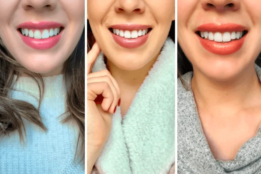 33663 teeth preparation