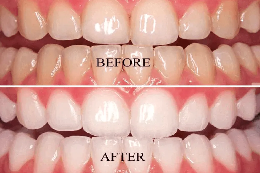 33663 teeth whitening results
