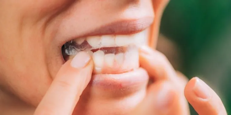 33670 teeth whitening process