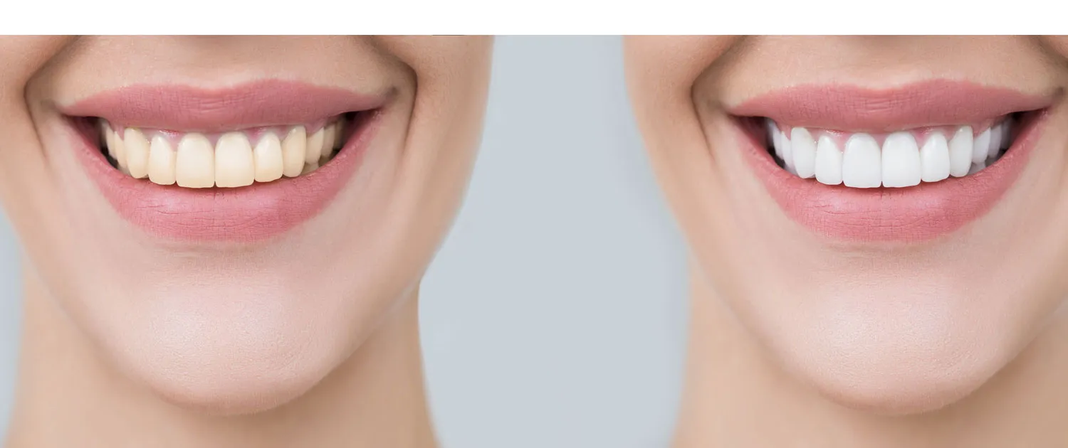 33672 in office teeth whitening