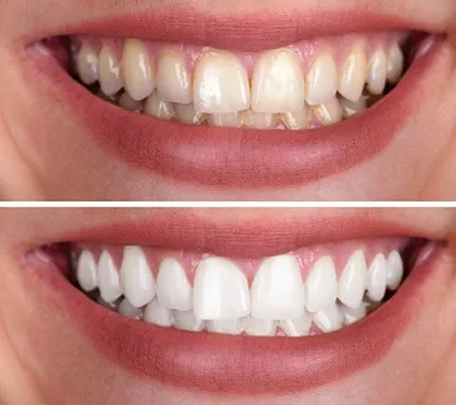 33677 professional teeth whitening