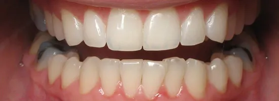 33677 stained teeth causes