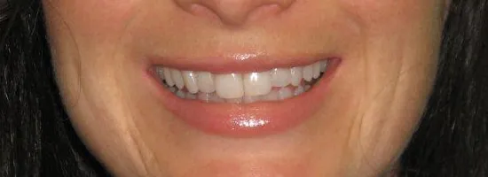 33677 teeth whitening methods