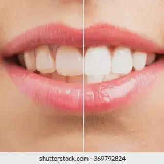 /img/33697-teeth-whitening-maintenance.webp