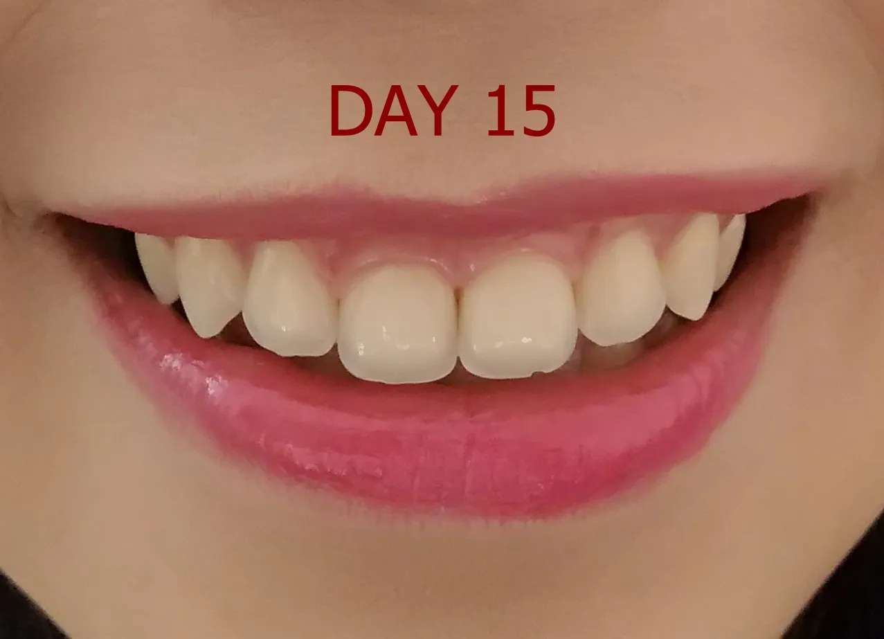 33698 crest whitening strips buying guide