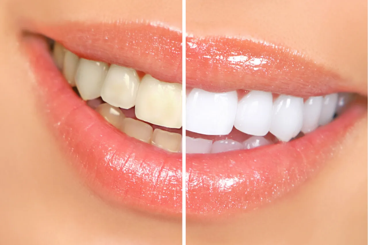 /img/33700-pay-monthly-teeth-whitening-options.webp