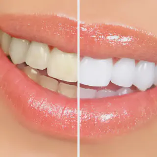 /img/33700-pay-monthly-teeth-whitening-options.webp