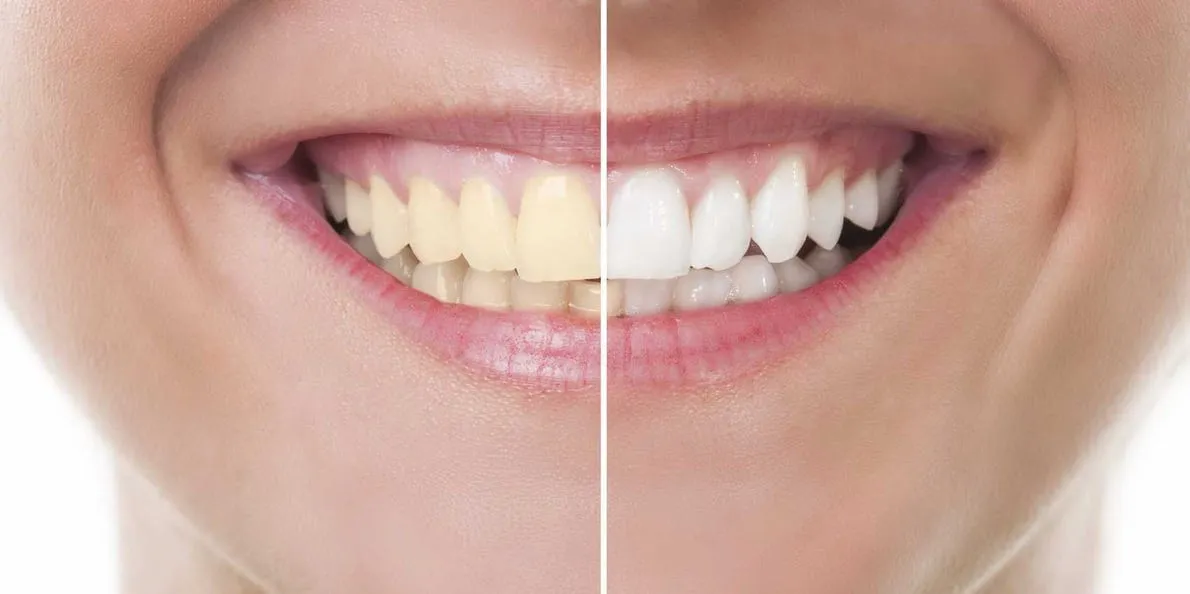 33705 teeth whitening process