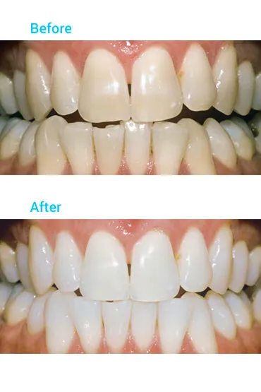 33706 teeth discoloration causes