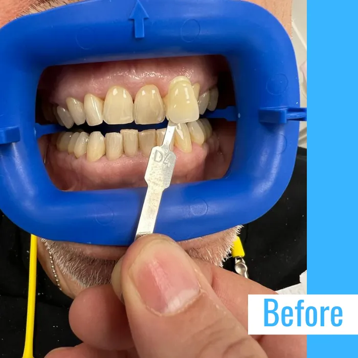 33712 teeth whitening treatment