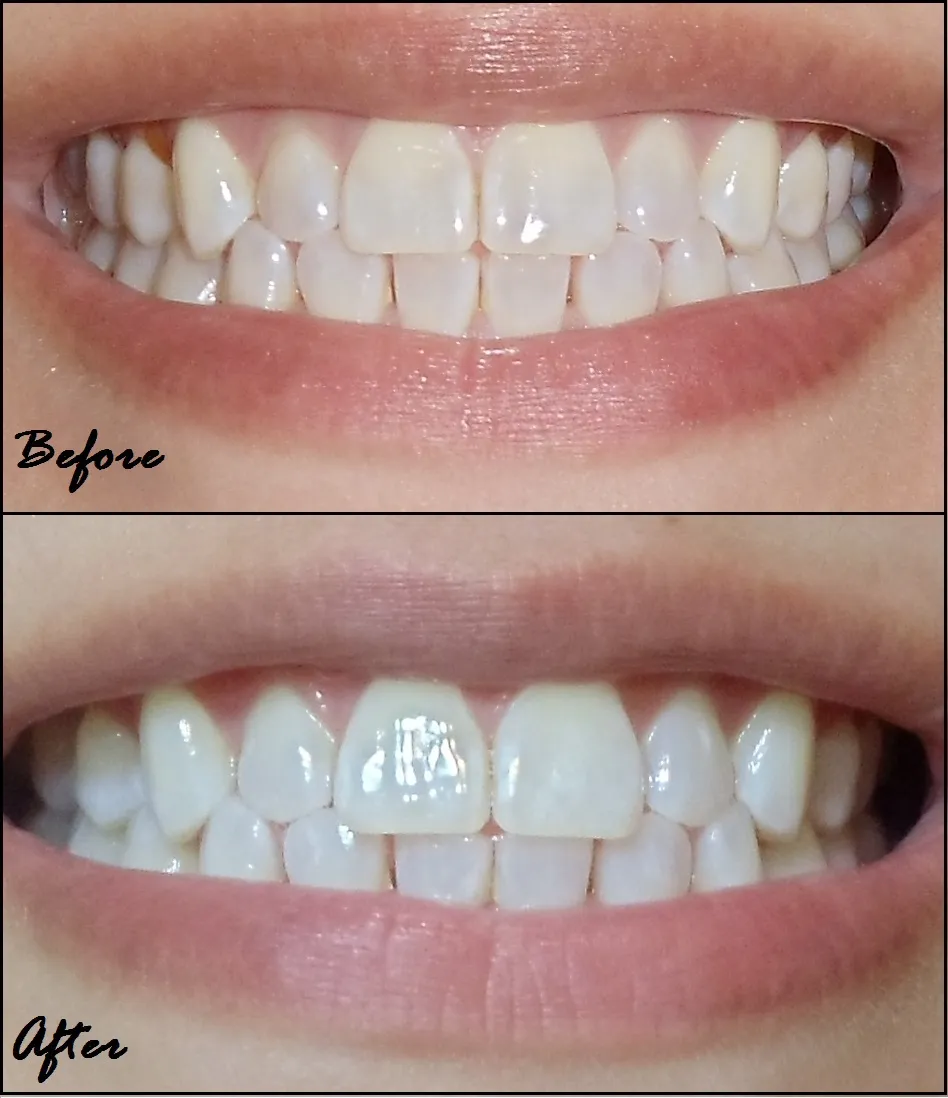 /img/33716-teeth-whitening-alternatives.webp