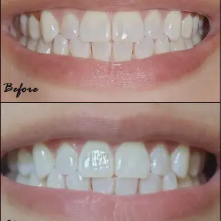/img/33716-teeth-whitening-alternatives.webp