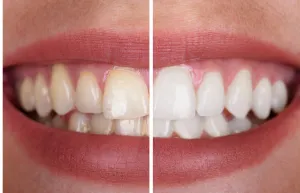 33723 maintaining teeth whitening