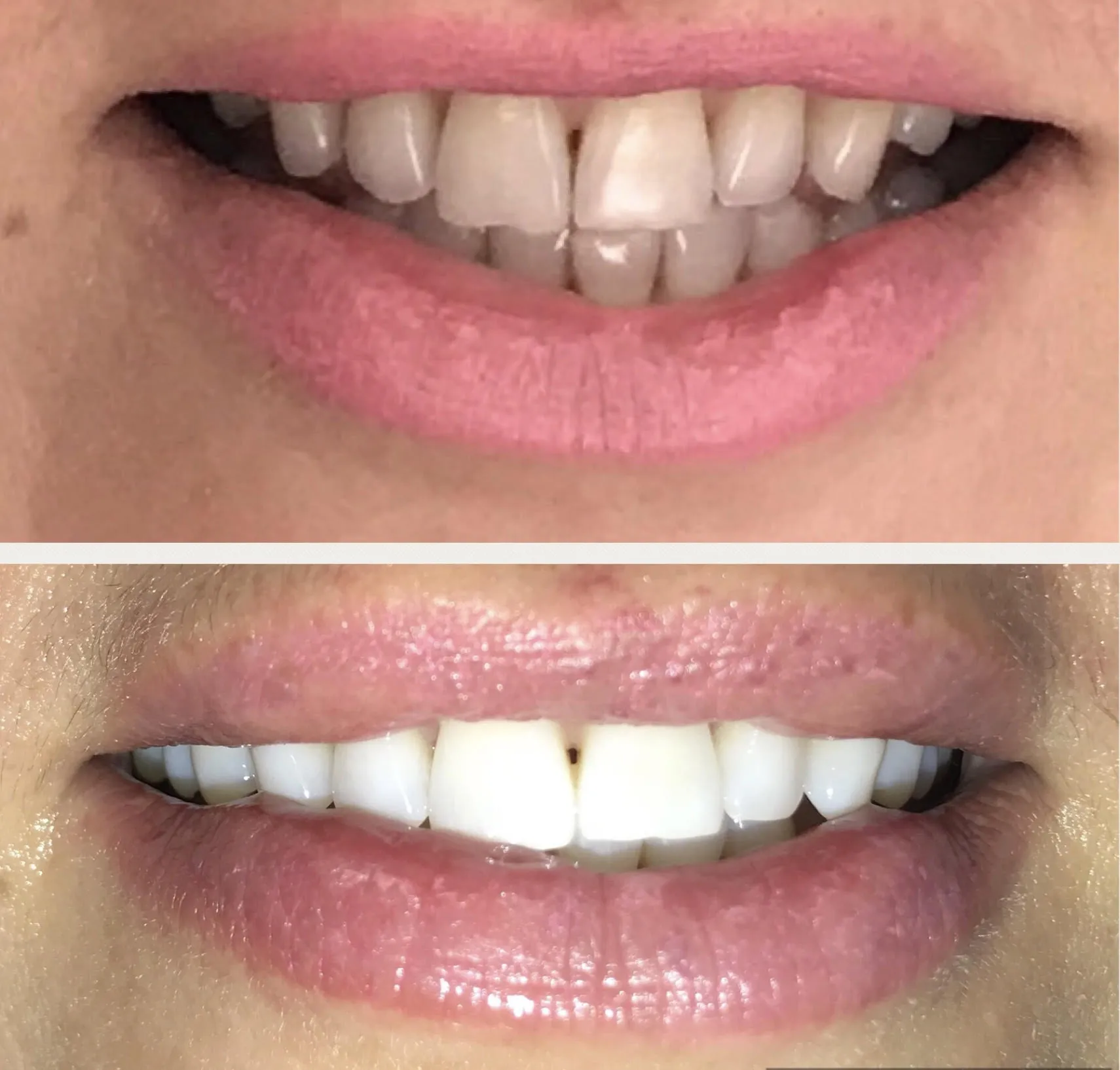 33723 teeth whitening technology