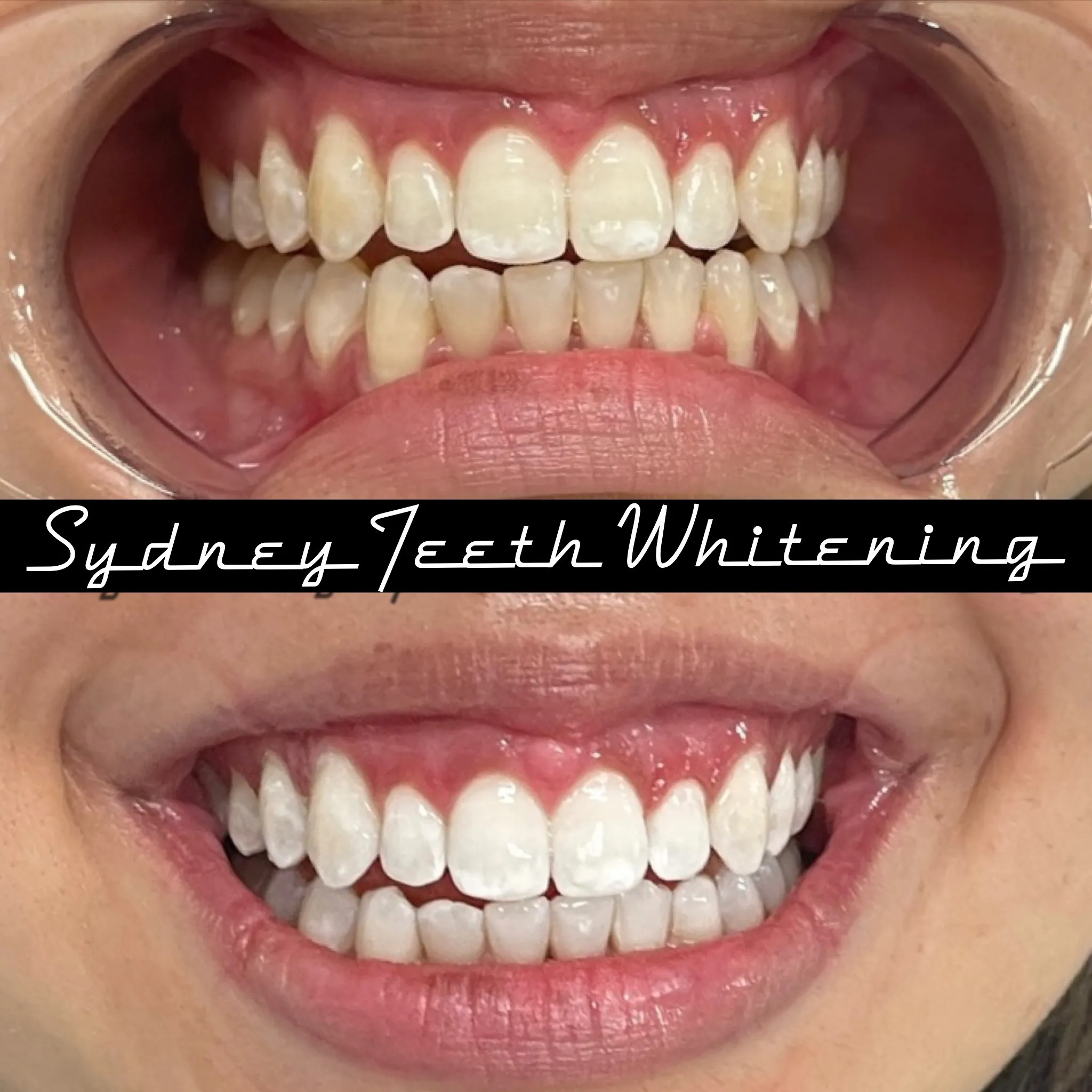 33729 staining teeth